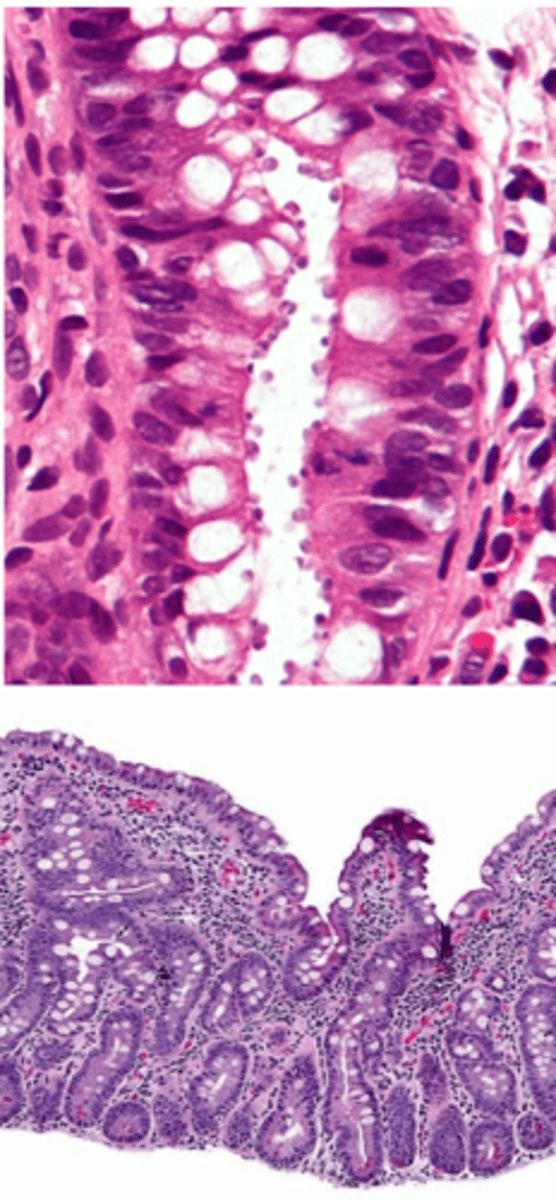<p>viven en los enterocitos → destrucción de enterocitos → atrofia de los vellosidades → síndrome de malabsorción</p>