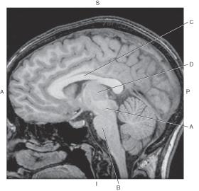 <p>Which line points to the corpus callosum?</p>