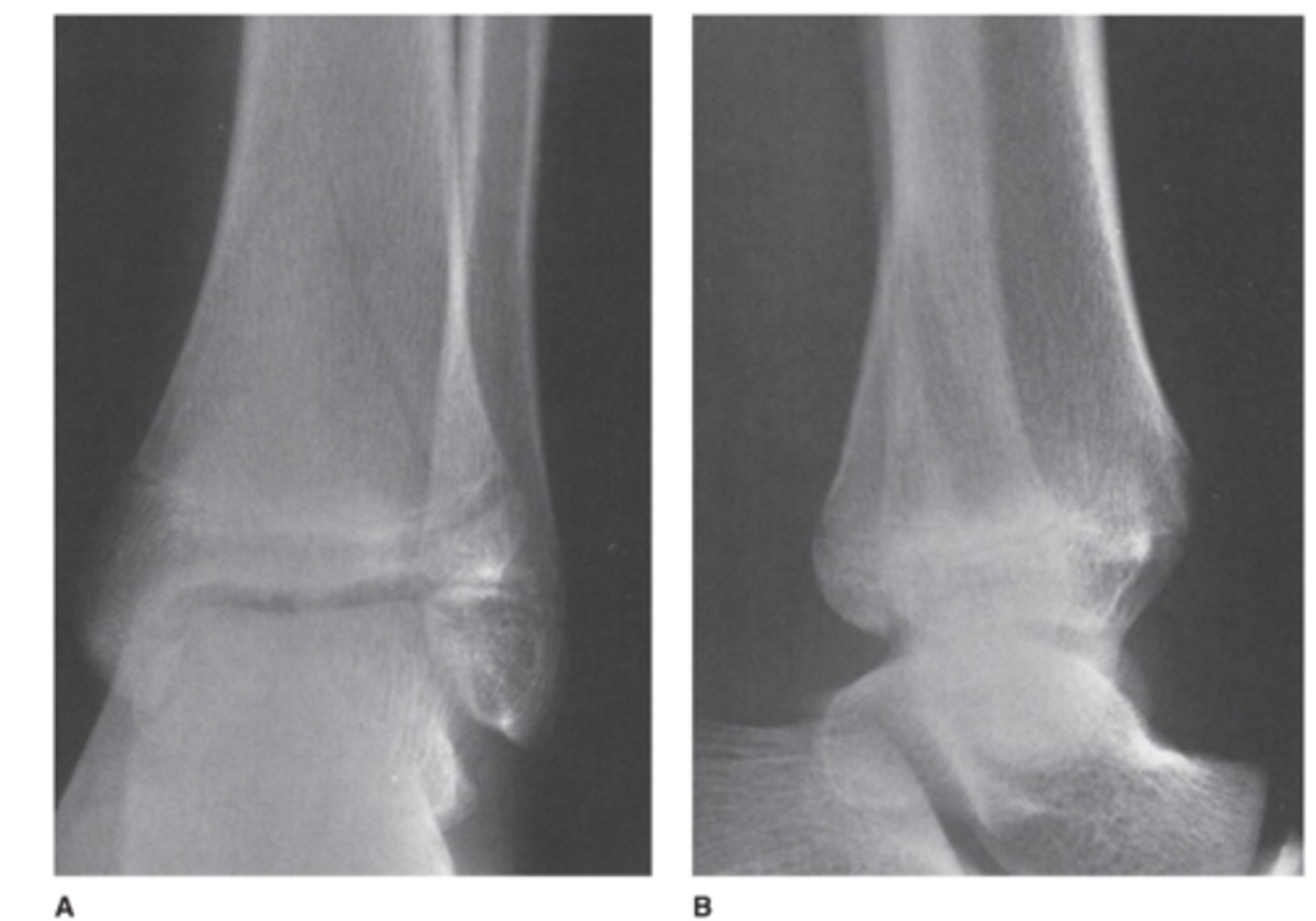 <p>What is the abnormality in Case 6-5 (Figure 6-12)?</p><p>A. Sprain of the lateral ligaments</p><p>B. Fracture of the distal fibula</p><p>C. Stress fracture of the talus</p><p>D. Triplane fracture of the distal tibia</p>