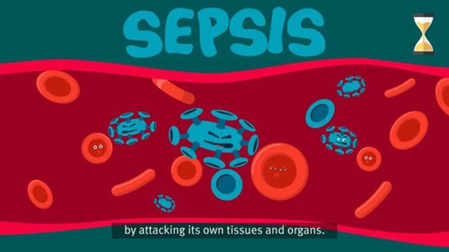 <p>A potentially life-threatening condition that occurs when the body's response to an infection damages its own tissues.</p>