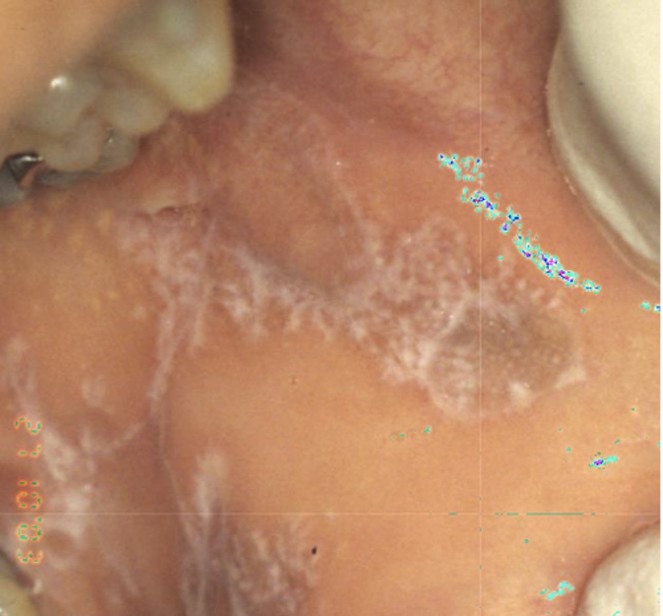 <p>What type of pigmented lesion?</p>