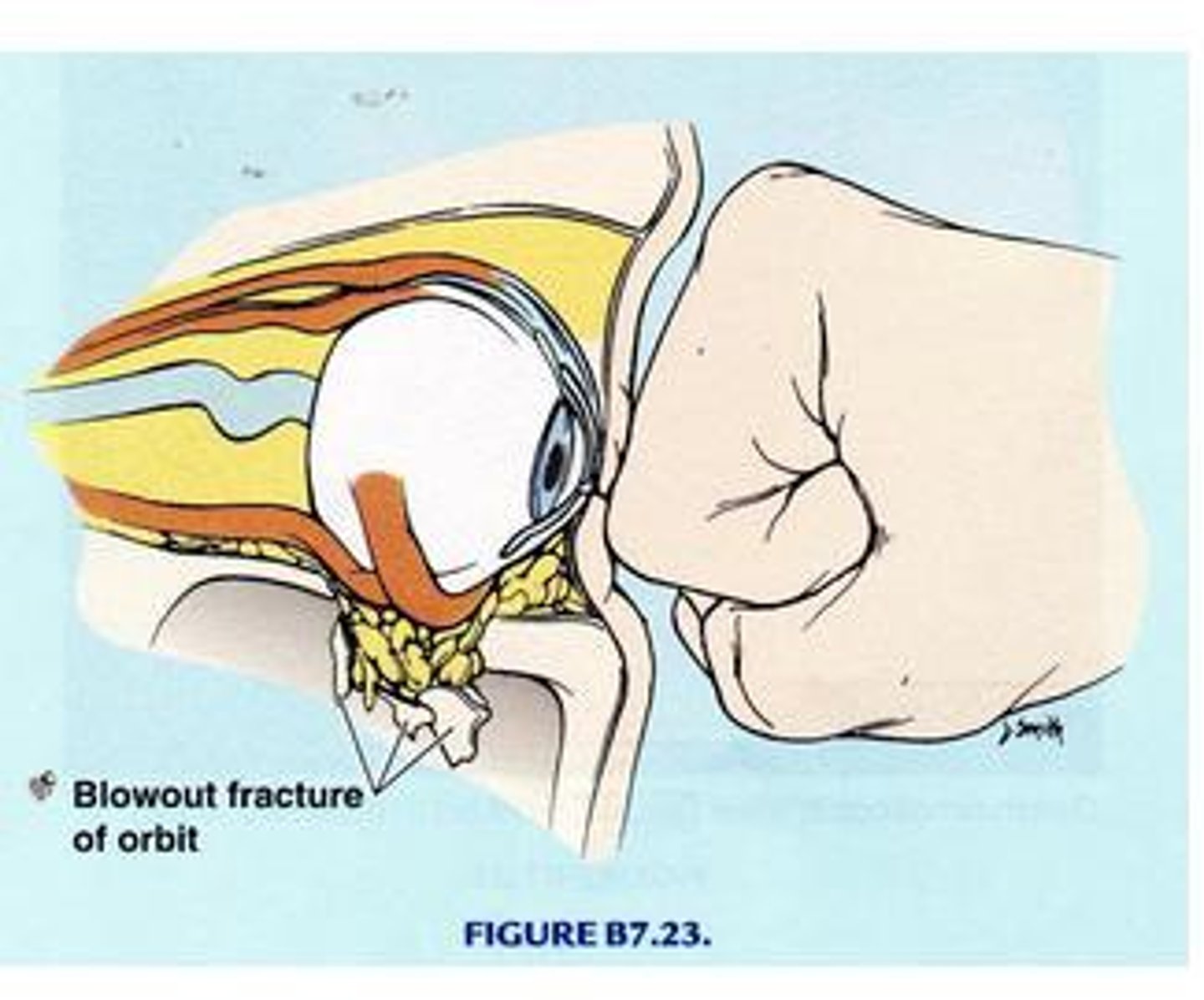 <p>orbital floor fractures</p>