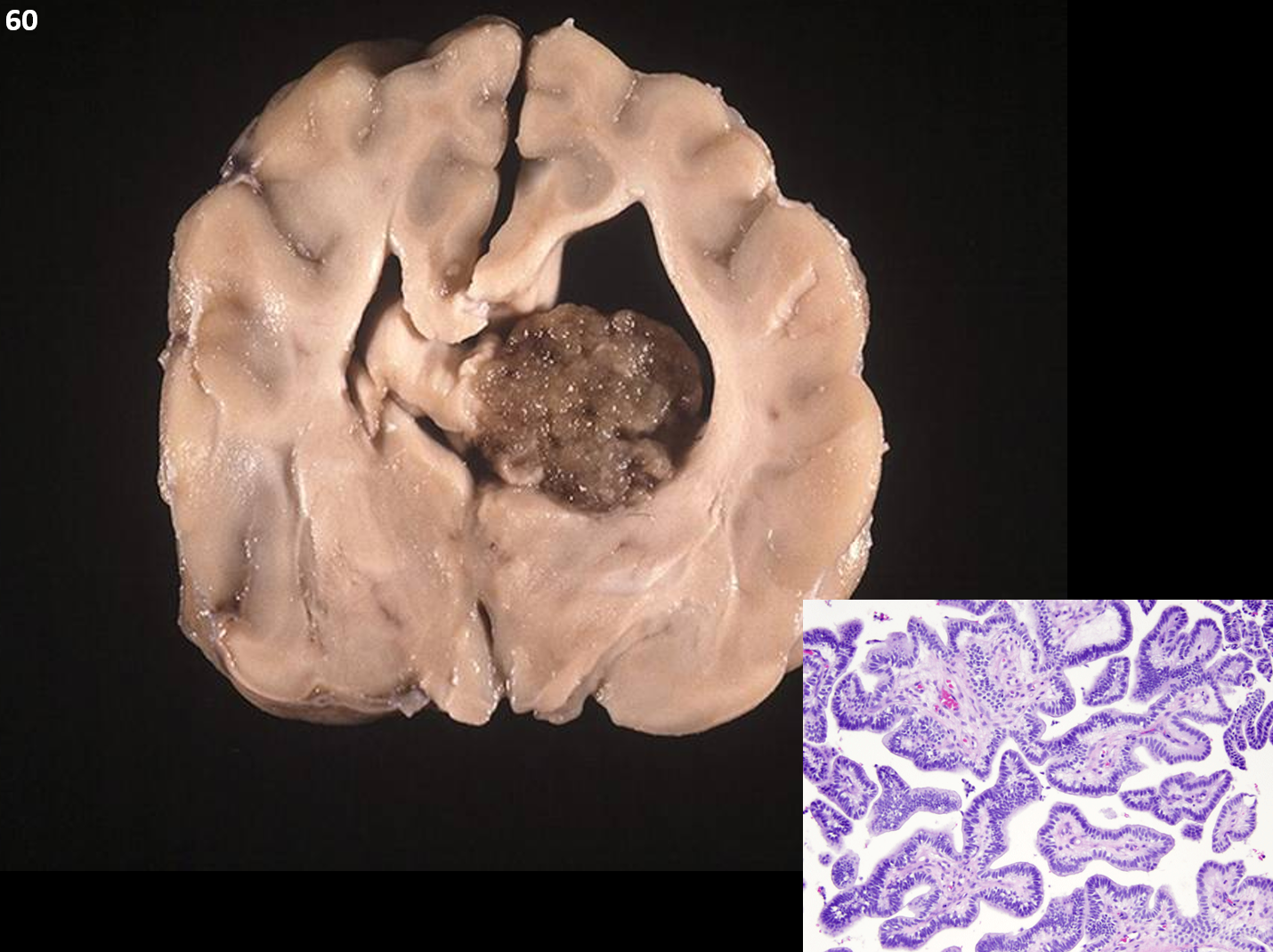 <p>60. Tissue from a dog. In a recent study, which of the following was NOT significantly correlated with histologic grade for this neoplasm?</p><p class="MsoListParagraphCxSpFirst"><span>a.</span><span style="font-size: 7pt; font-family: &quot;Times New Roman&quot;">&nbsp;&nbsp;&nbsp;&nbsp; </span>Mitotic index</p><p class="MsoListParagraphCxSpMiddle"><span>b.</span><span style="font-size: 7pt; font-family: &quot;Times New Roman&quot;">&nbsp;&nbsp;&nbsp;&nbsp; </span>Intraventricular spread</p><p class="MsoListParagraphCxSpMiddle"><span>c.</span><span style="font-size: 7pt; font-family: &quot;Times New Roman&quot;">&nbsp;&nbsp;&nbsp;&nbsp; </span>Cell density</p><p class="MsoListParagraphCxSpLast"><span>d.</span><span style="font-size: 7pt; font-family: &quot;Times New Roman&quot;">&nbsp;&nbsp;&nbsp;&nbsp; </span>Multilayering of papillae</p>