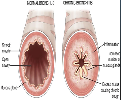 <ul><li><p>An inflammation of the bronchioles and bronchi caused by chronic exposure to irritants (What is</p><p>the most common irritant?)</p><ul><li><p><strong><mark data-color="yellow" style="background-color: yellow; color: inherit;"><u>Smoke from cigarettes</u></mark></strong></p></li></ul></li><li><p>Irritant triggers inflammation, vasodilation, congestion, mucosal edema, and bronchospasms</p></li><li><p>Hypersecretion of mucus for at least 3 months</p></li><li><p><u>Ciliary function is reduced</u>, bronchial walls thicken, <u>airway becomes narrow</u></p></li><li><p><strong>Alveoli become damaged and fibrosed</strong></p></li><li><p><strong>Chronic inflammation</strong> causes increase in number and size of mucous glands which produce increased amounts of<strong> thick mucous.</strong></p></li><li><p>Thick bronchial walls plus increased mucous block smaller airways and narrow large airways</p></li><li><p><strong><u>Clinical manifestations</u></strong></p><ul><li><p>Productive cough</p></li><li><p>Dyspnea</p></li><li><p>Cyanosis</p></li><li><p>use of accessory muscles</p></li><li><p>Cor pulmonale</p></li></ul></li></ul><p></p>