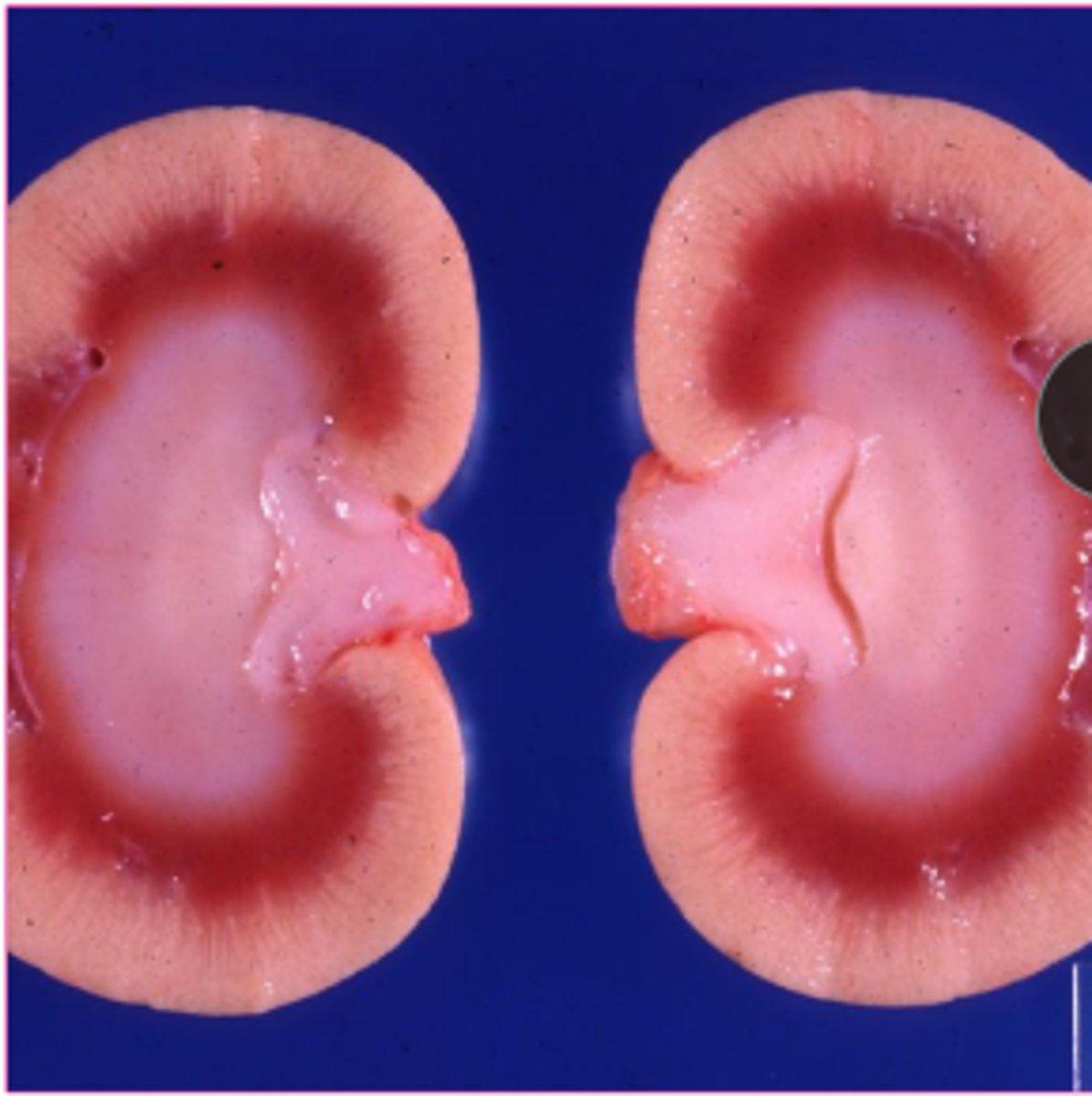 <p>accumulation of lipids within parenchyma cells</p>