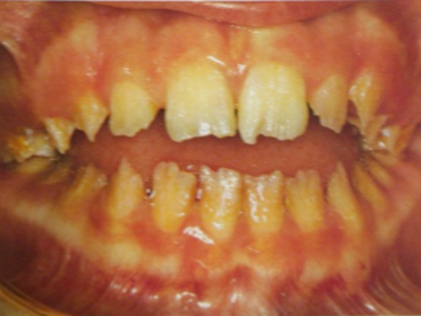 <p>Hypoplasia of dental structures can cause what type of problems?</p>