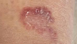 <p><span>A special type of inflammation characterized by accumulations of macrophages, some of which coalesce into "giant cells." Granulomatous inflammation is especially characteristic of tuberculosis, some deep fungal infections, sarcoidosis, reaction to foreign bodies and several skin diseases of unknown cause.</span></p>