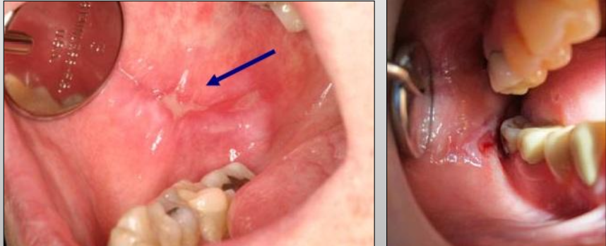 <p>Lesions that result from the direct contact of an allergen with the oral mucosa and skin</p>