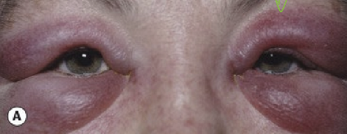 <p>Systemic antihistamines=oral medications </p>