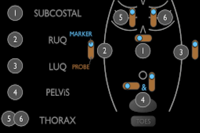 <p>bedside ultrasound protocol design to <strong>detect peritoneal fluid, pericardial fluid, pneumothorax and/or hemothorax in trauma patient</strong></p>