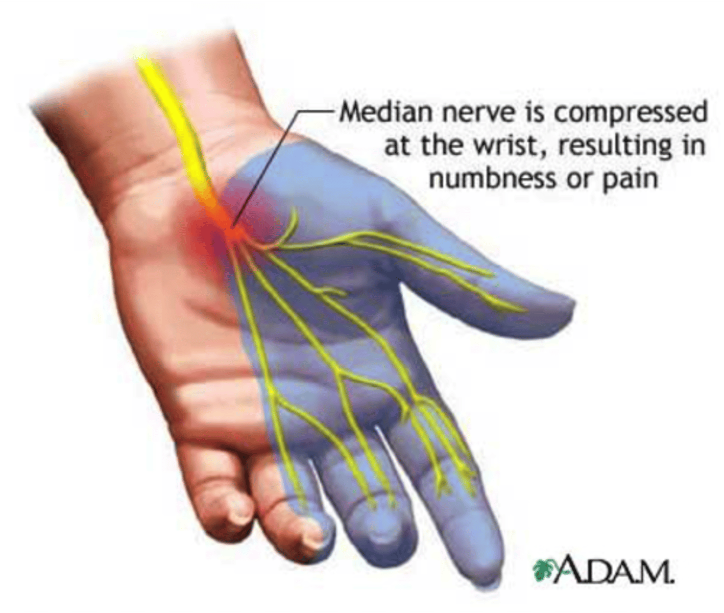 <p>Median nerve compression in wrist</p>