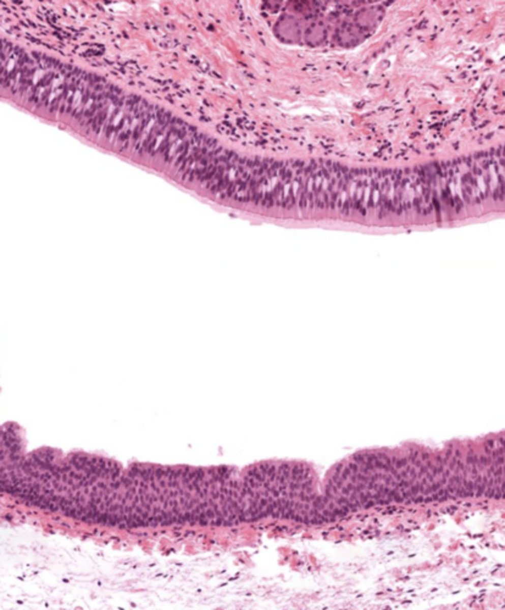 <p>Pseudostratified ciliated epithelium -> stratified squamous epithelium (image is at the vestibular folds)</p>