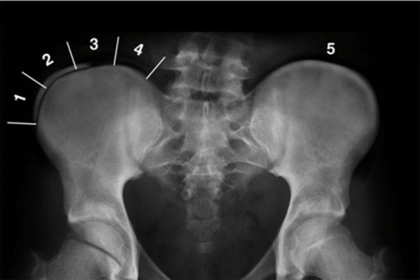 <p>Risser's Classification Stage _____: apophysis over 25-50% of the iliac crest</p>