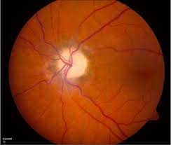 <p>degeneration of the optic nerve, leading to a pale optic disc and progressive, usually permanent, vision loss.</p>