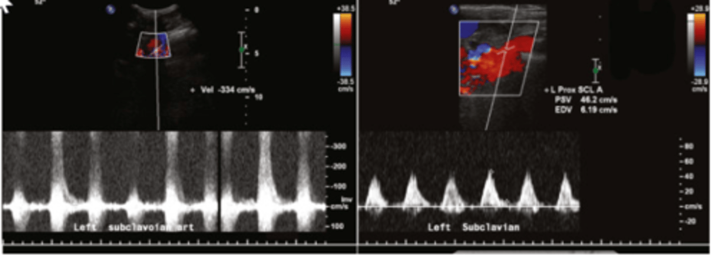 <p>>50% stenosis of the proximal subclavian artery</p>