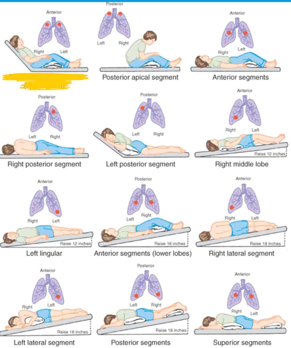 <p>Which lung segment does this position effect</p>