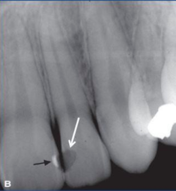 <p>most likely cause of this radiolucency </p>