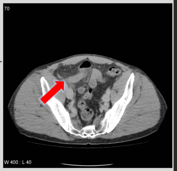 <p>What is the role of CT in diagnosing appendicitis?</p>