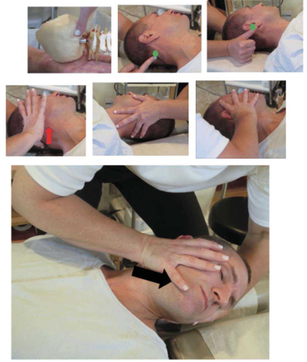 <p>• PP: Supine, permission to contact the neck, identify how you found the segment, doctor supporting the patients head off the end of the table, patients had turned away from the side of dysfunction,</p><p>• DP: Towards head of table, on side of contact, angled 45°-90° to the patient, distract with legs, tissue slack M-L</p><p>• CH: Thumb of the hand corresponding to the side of segmental contact, posterior aspect of the mastoid, contact hand is arched to cup over the patient's ear, fingers resting on the angle of the jaw, forearm down the sternum</p><p>• IH: #1• VEC: P-A and I-S (Induce LAD with corkscrew-like motion)</p><p>Avoid inducing excessive upper cervical rotation</p><p>**alternate contact hand- index, thenar or hypothenar</p>