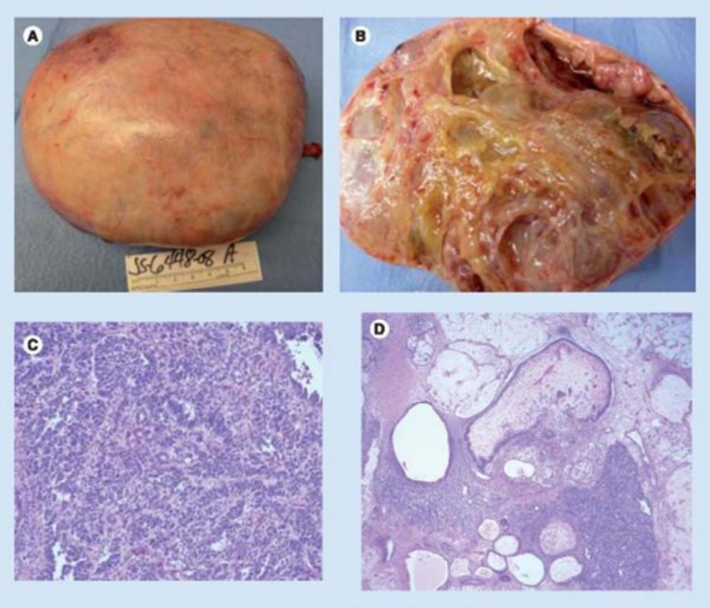 <p>Tumor resection.</p>