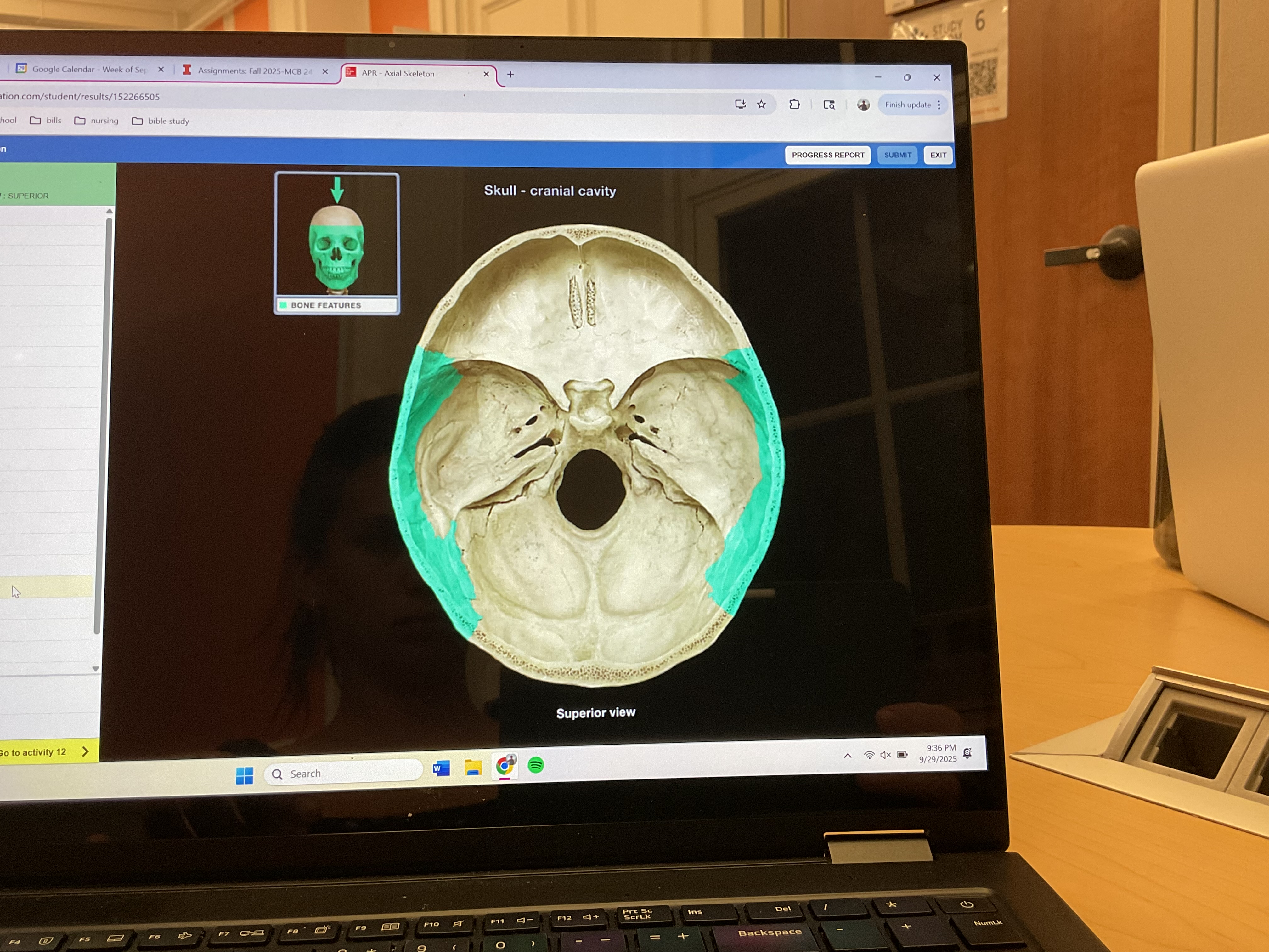 <p>Parietal bone </p>