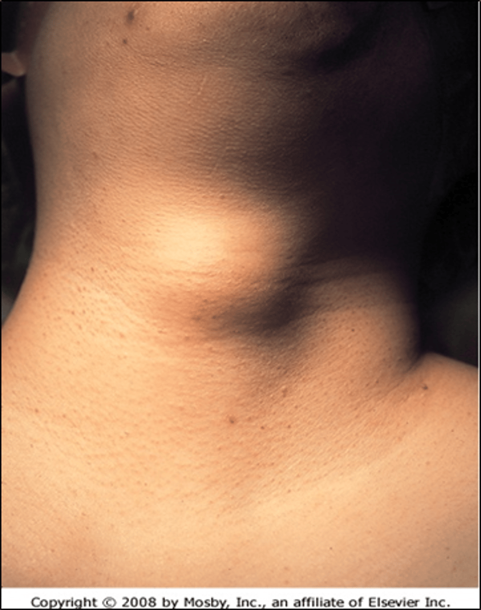 <p>Dz: Midline cystic mass in neck</p><p>Sx: </p><p>- Asymptomatic if not infected</p><p>- Swelling/airway compromise with infection</p><p>- Vertical motion of mass with swallowing and tongue protrusion (PATHOGNOMONIC!!)</p><p>Tx: Surgery</p>