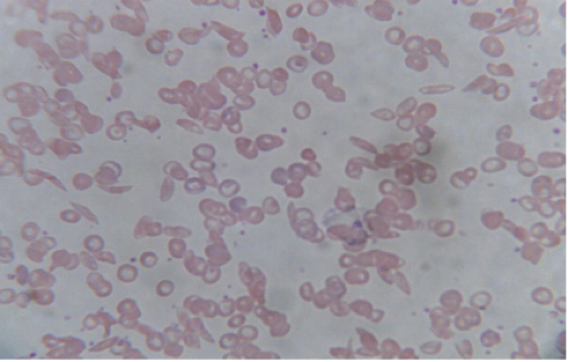 <ul><li><p>RBCs are curved or crescent shaped </p></li><li><p>Cells cannot get enough oxygen since capillaries get blocked by crescent-shaped cells</p></li></ul><p></p>