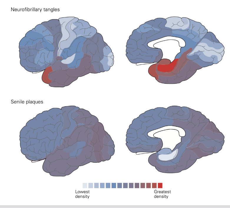 <ul><li><p>amyloid plaques</p><ul><li><p>vrij diffuus in de hersenen opstapelen</p></li><li><p>vrij vroeg in ziekteproces</p></li><li><p>niet per se gecorreleerd met ernst van symptomen</p></li></ul></li><li><p>tau</p><ul><li><p>sterke correlatie met neuronale schade & zowel ernst als aard van symptomen</p></li></ul></li></ul><p></p>