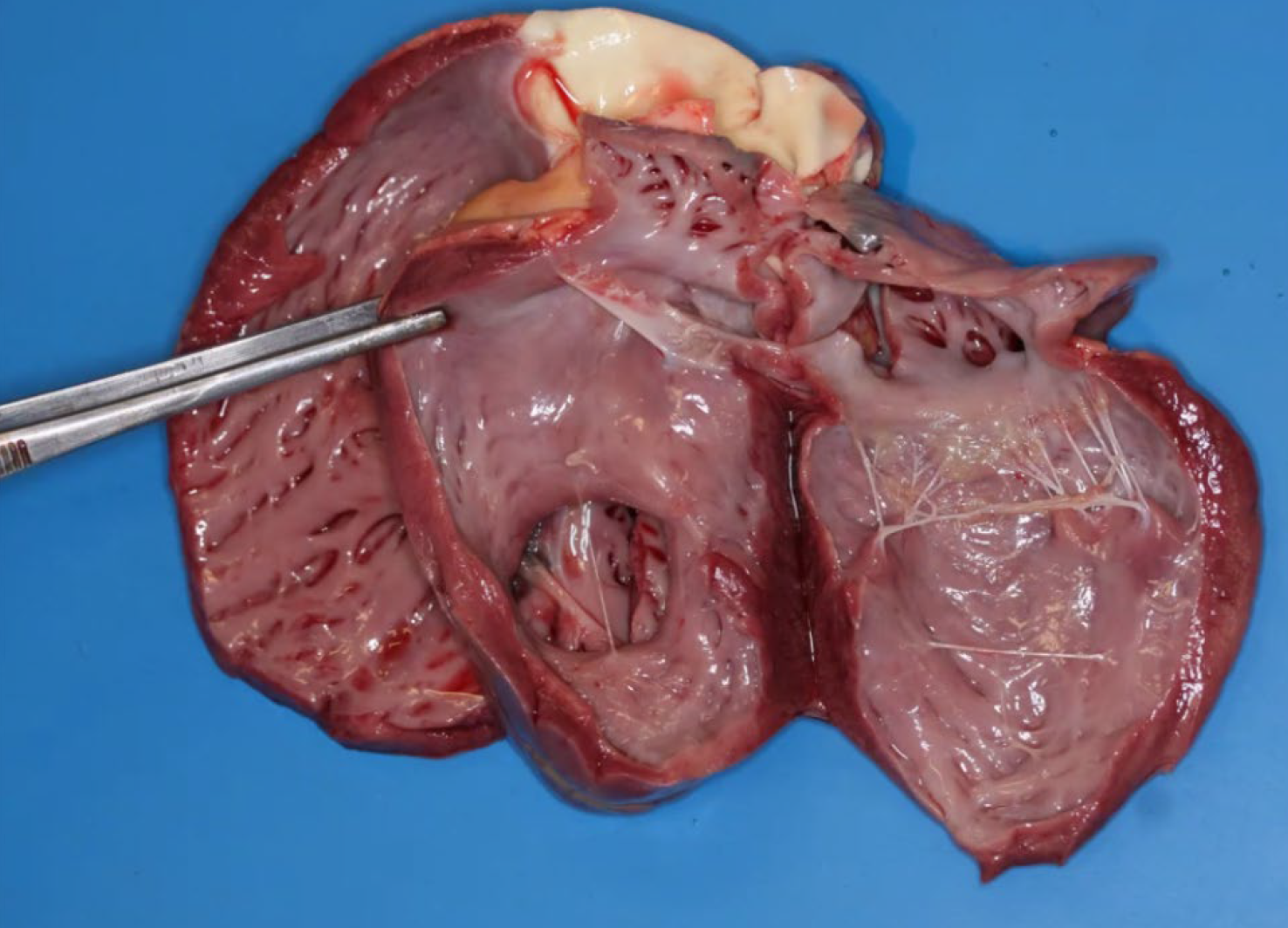 <p>Calf. Lesions can be also seen in what organ?</p><p>A-Liver</p><p>B-Brain</p><p>C-Thyroid gland</p><p>D-Kidneys</p>