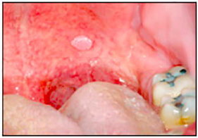 <p><span style="color: blue;"><strong><em><u>SPECIFIC INFECTIONS</u></em></strong></span></p><p>Squamous Cell Papilloma</p><ul><li><p>Clinical Signs</p></li><li><p>Etiology</p></li><li><p>Treatment</p></li></ul><p></p>