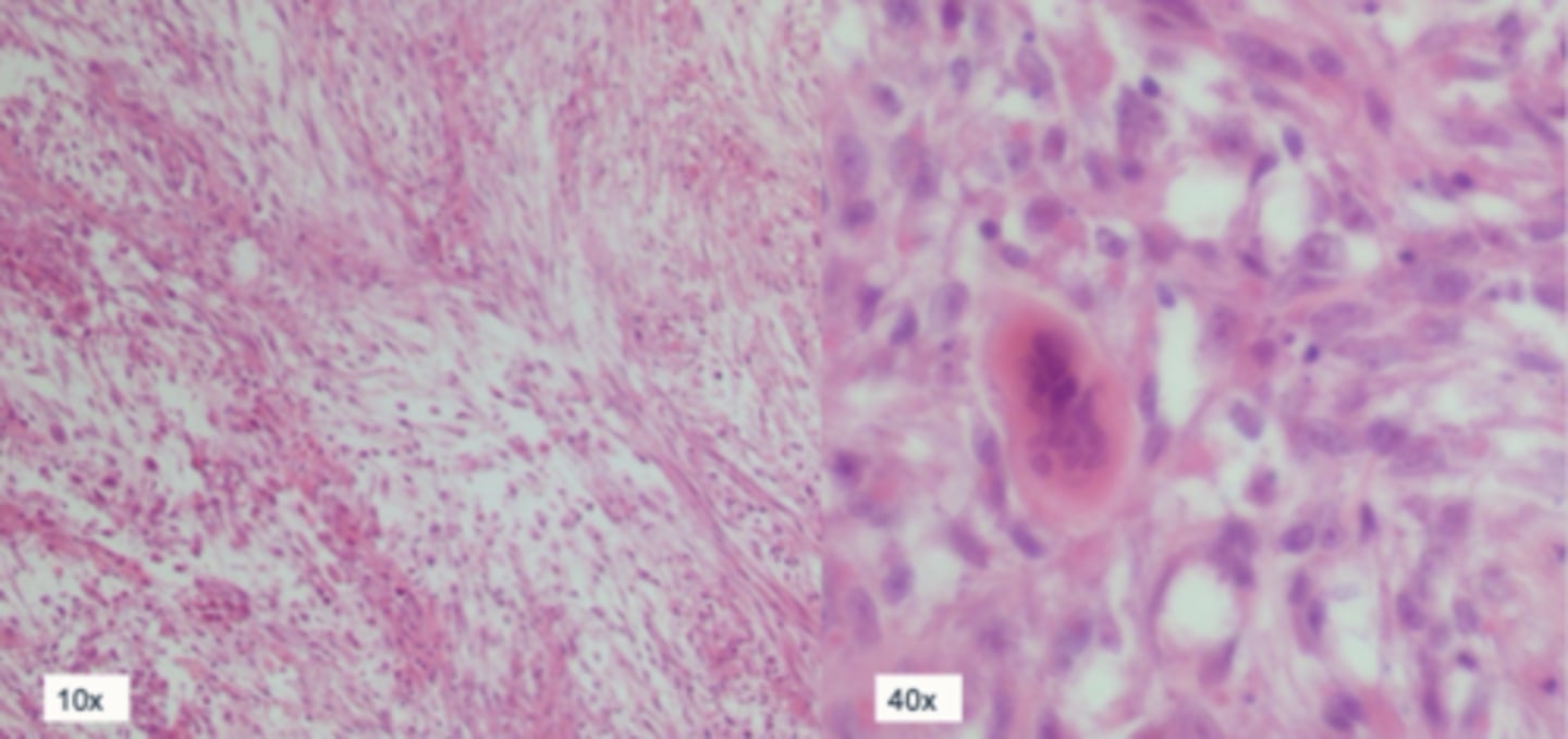 <p>Case 2 histopathology - why would we send this off for histo?</p>