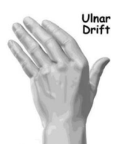 <p>What type of orthosis can be used for ulnar drift? What classification does it fall under?</p>