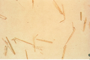<p>Identify the urine sediment element shown:</p>