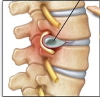<p><strong><mark data-color="rgba(0, 0, 0, 0)" style="background-color: rgba(0, 0, 0, 0); color: inherit;">occurs when the soft, jelly-like center of a spinal disc pushes through a tear in its tough, outer layer</mark></strong><span><span>. This material presses on nearby spinal nerves, causing pain, numbness, or weakness in the back, neck, or limbs</span></span></p>