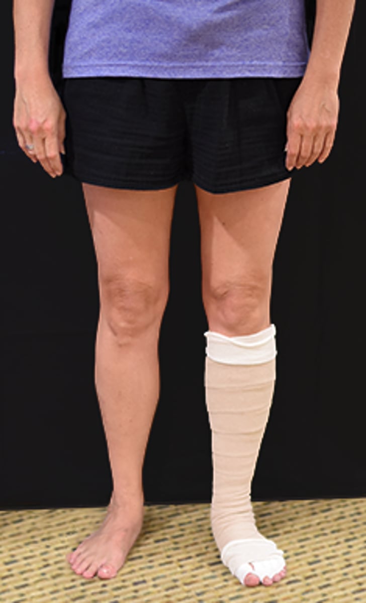 <p>2. A deep, dry, regularly shaped wound</p><p>Rationale</p><p>1. A Stemmer sign is positive if the skin on the dorsum of the toes and fingers cannot be lifted, or is difficult to lift, compared to the opposite side. Presence of a Stemmer sign is considered to accurately diagnose the presence of lymphedema (p. 73.) Therefore, presence of a Stemmer sign, in the absence of peripheral arterial disease, would indicate that multilayered compression bandaging may be beneficial (pp. 272-273).</p><p>2. Multilayered compression bandaging or "lymphedema bandaging" is a technique used to provide compression therapy during the first phase of complete decongestive therapy (pp. 272-273). A wound that is deep, regularly shaped, and dry is most likely an arterial wound (p. 141). Compression therapy is contraindicated for management of edema in the presence of peripheral arterial disease (p. 267).</p><p>3. A superficial, irregularly shaped, highly exudative wound is most likely a venous ulcer (p. 141). Compression therapy is considered one of the most important therapeutic measures for prevention and treatment of venous leg ulcers (pp. 272-273). When applying multilayered compression bandaging to an extremity with a venous ulcer, the physical therapist may incorporate materials or medications prescribed by the physician into the bandaging to manage the wound (p. 82). Therefore, the presence of a venous ulcer is not a contraindication to using multilayered compression bandaging.</p><p>4. Papillomas and hyperkeratosis are common dermal abnormalities that occur in the presence of chronic lymphedema (pp. 79-80). These dermal changes do not prohibit the use of multilayered compression bandaging.</p>