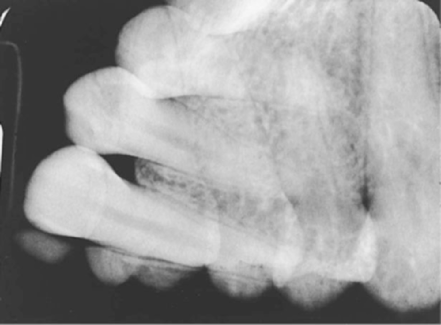 <p>-Superimposed x-ray images</p><p>-Accidentally exposing film twice</p><p>-Maintain a systematic order to exposing radiographs</p><p>-FMX = Anterior to posterior</p><p>-BW = Premolars to Molars</p>