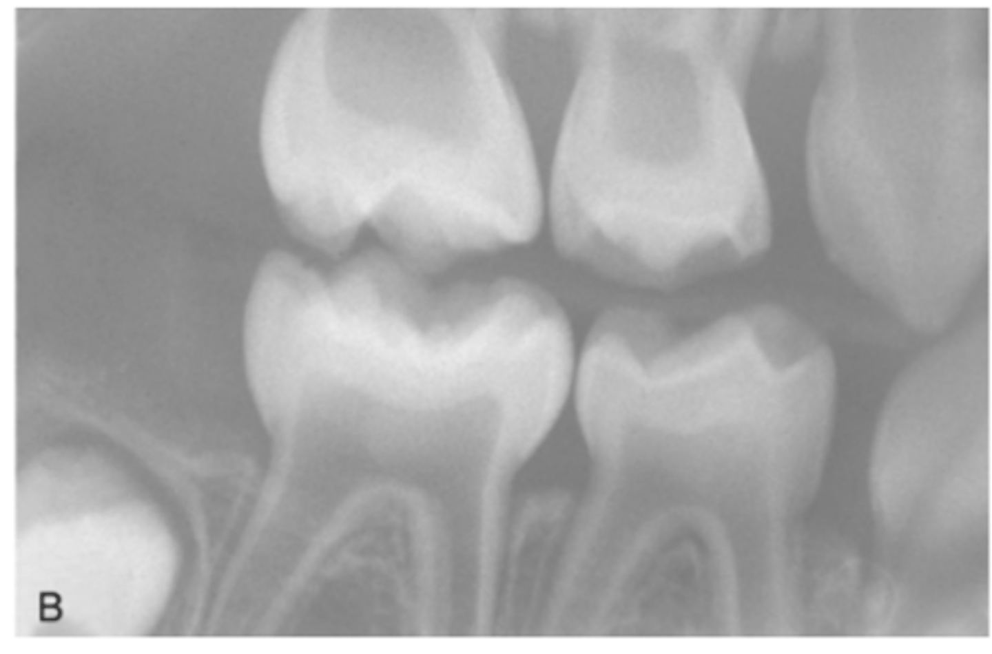 <p>What are some radiographic signs seen in Osteogenesis Imperfecta </p>