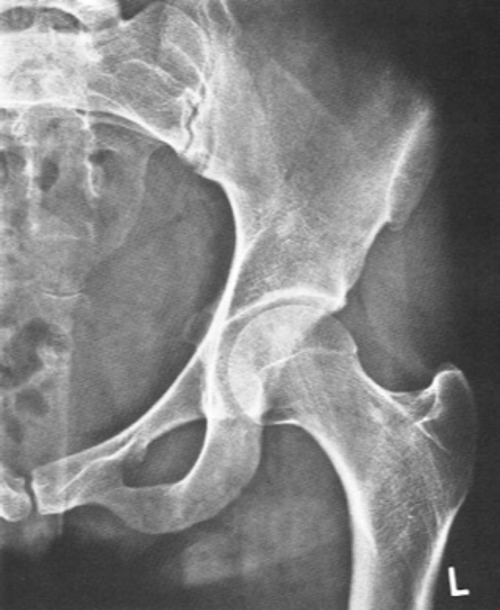 <p>ID standard unilateral hip projection</p>