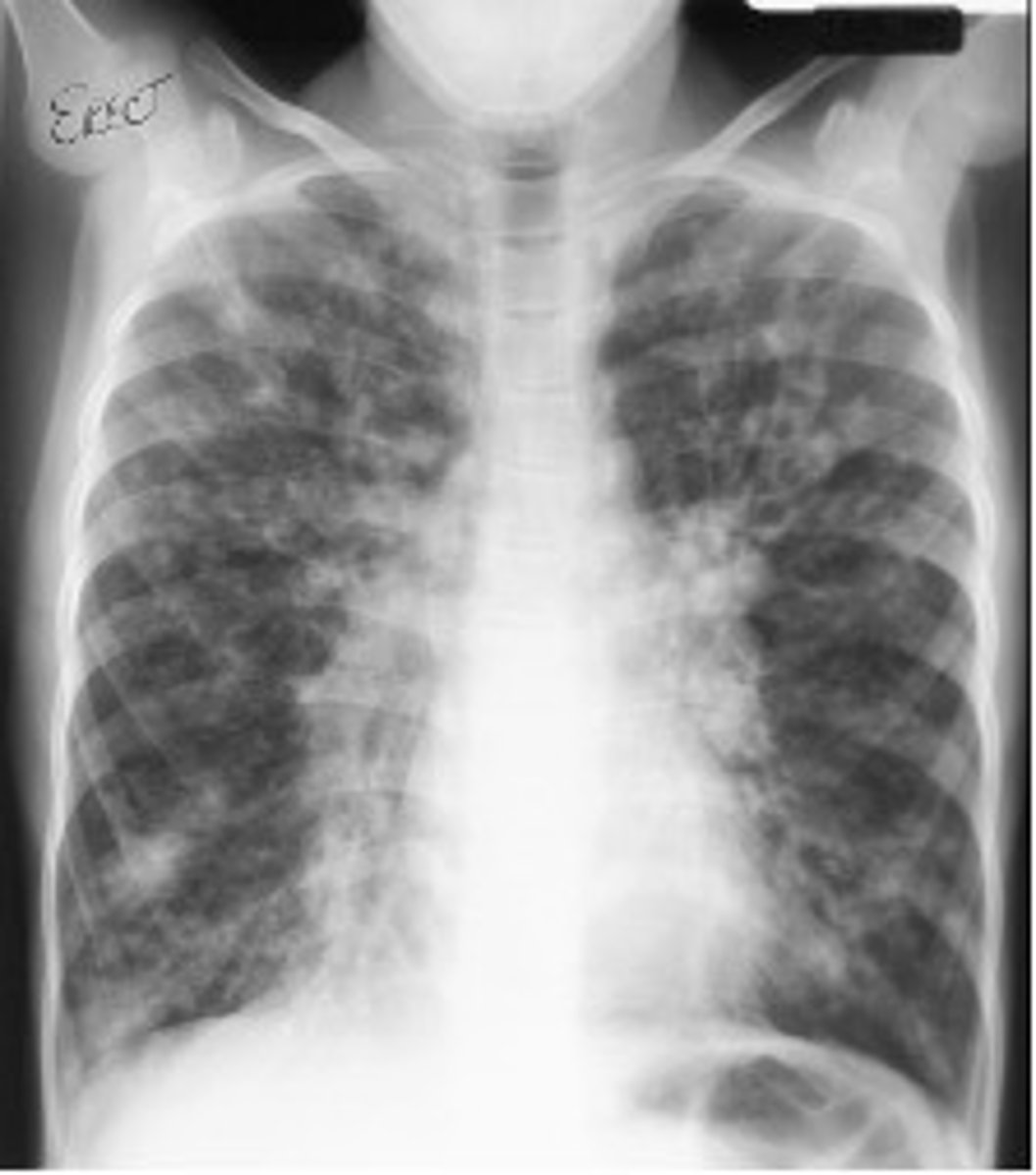 <p>cystic fibrosis</p>