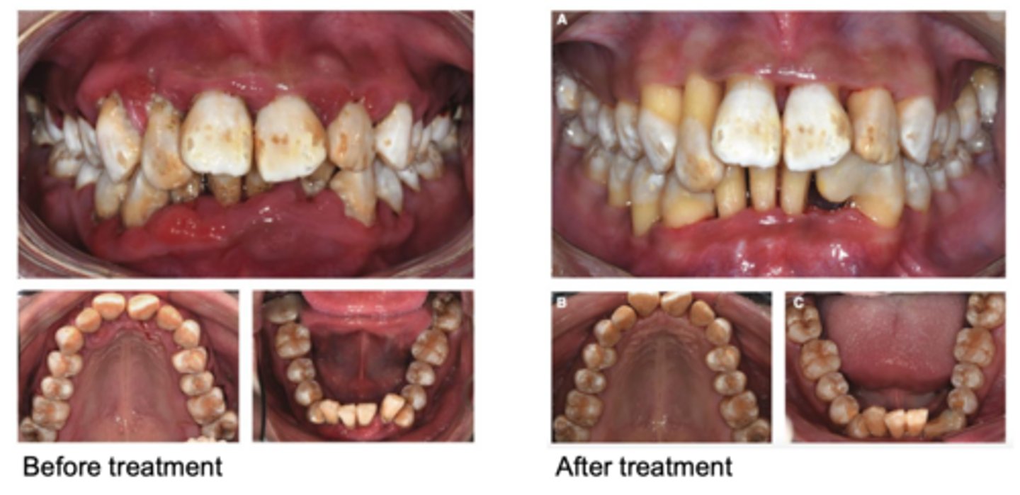 <p>A 21-year-old female was referred to the dental center, complaining of halitosis and swollen and painful gums, which lasted 2 months. The patient has a history of diabetes, which was diagnosed around 11 years ago.</p><p>What are some managament considerations?</p>