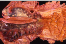 <p>Give a morphological diagnosis</p>