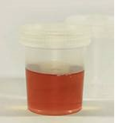 <p><span>How would you document the characteristic of this urine?</span></p><p></p>
