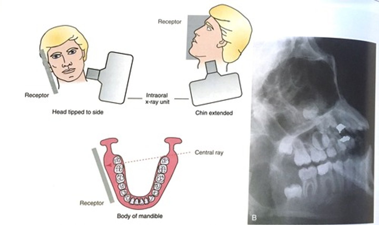 <p>- below of mandible</p><p>- vertical angulation -15 to -20</p>