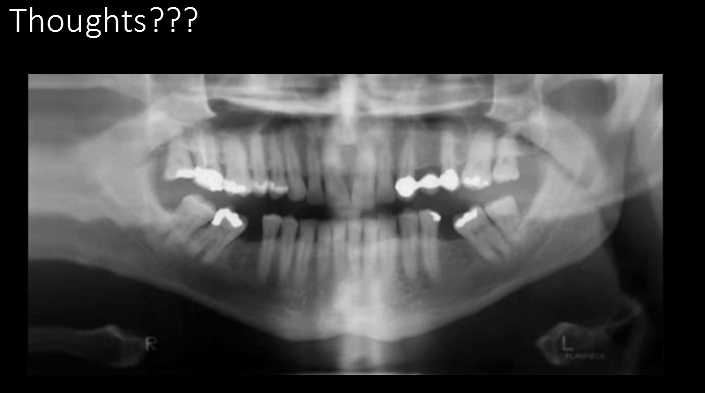 <p>Pano. hit shoulder and dragged</p><p>Must check for shoulder clearance; walk around the patient, look from each side. </p>