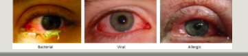 <p>conjunctivitis</p>