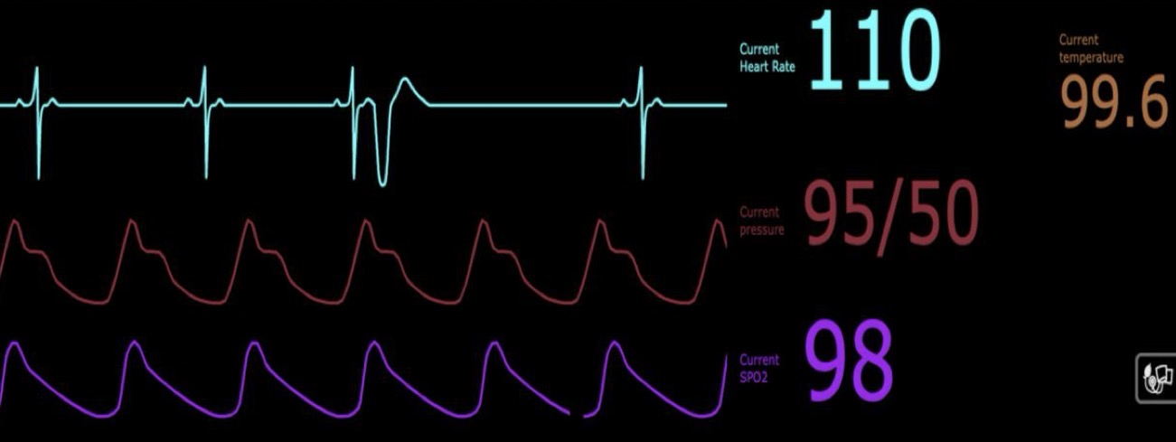 <p>What type of arrhythmia is demonstrated in this case?</p>