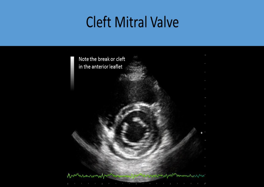 <p>split or tear in one or both of the mitral valve leaflets, psax view most often shows a divison of the anterior leaflet, sometimes making the valve appear as though it has 3 leaflets</p>
