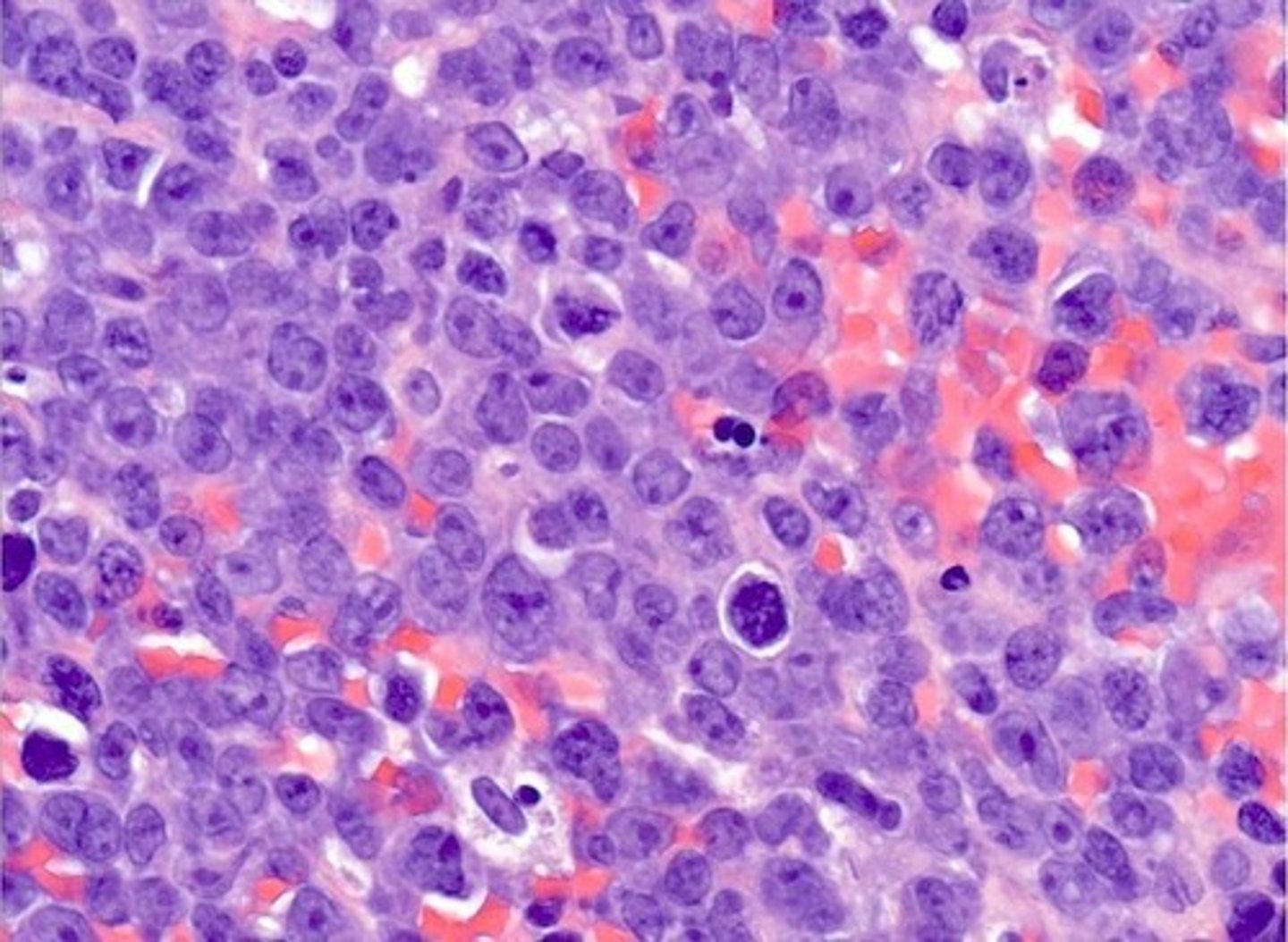 <p>Cells seen in multiple myeloma; flame cells are plasma cells with a distinct appearance, and Russell bodies are abnormal immunoglobulin accumulations.</p>