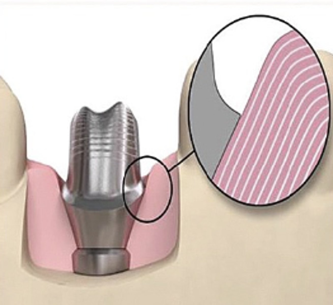 <p>What type of abutment?</p><p>- Anatomically shaped abutment will be up to 0.2 mm larger than the sulcus of the silicone model of soft tissue provided with the desired emergence profile</p><p>- "Easy" insertion</p>