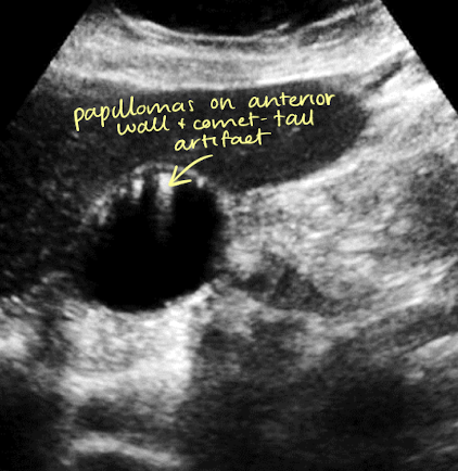 <p><mark data-color="yellow" style="background-color: yellow; color: inherit;"><span>adenomyomatosis</span></mark></p>